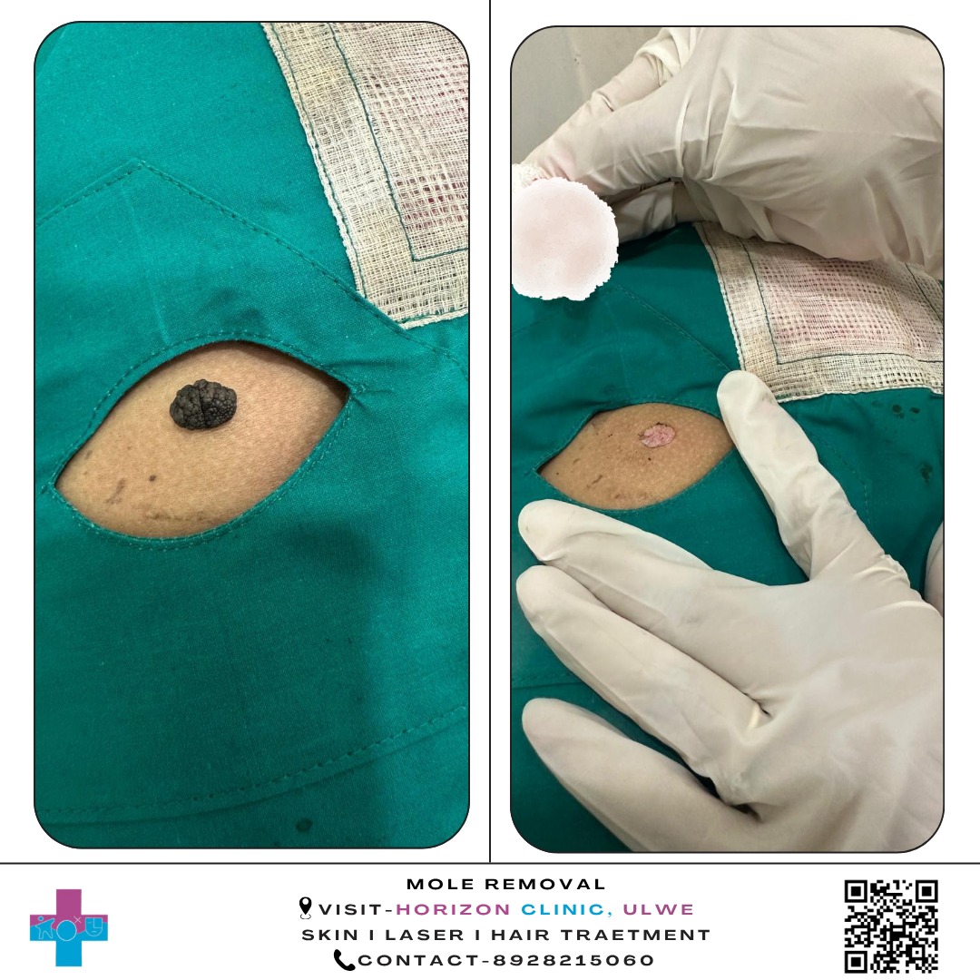Aesthetic Mole Removal